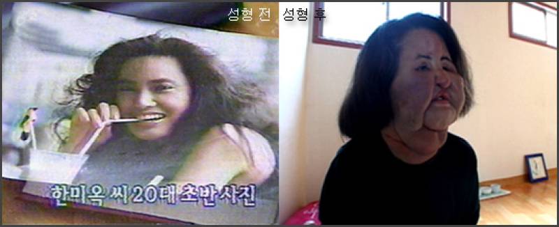 故 한혜경 7주기, 불법 성형 비극